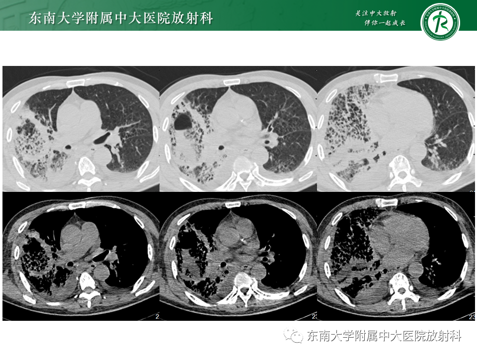 影像PPT - 【PPT】“反晕征”相关病变及鉴别-8