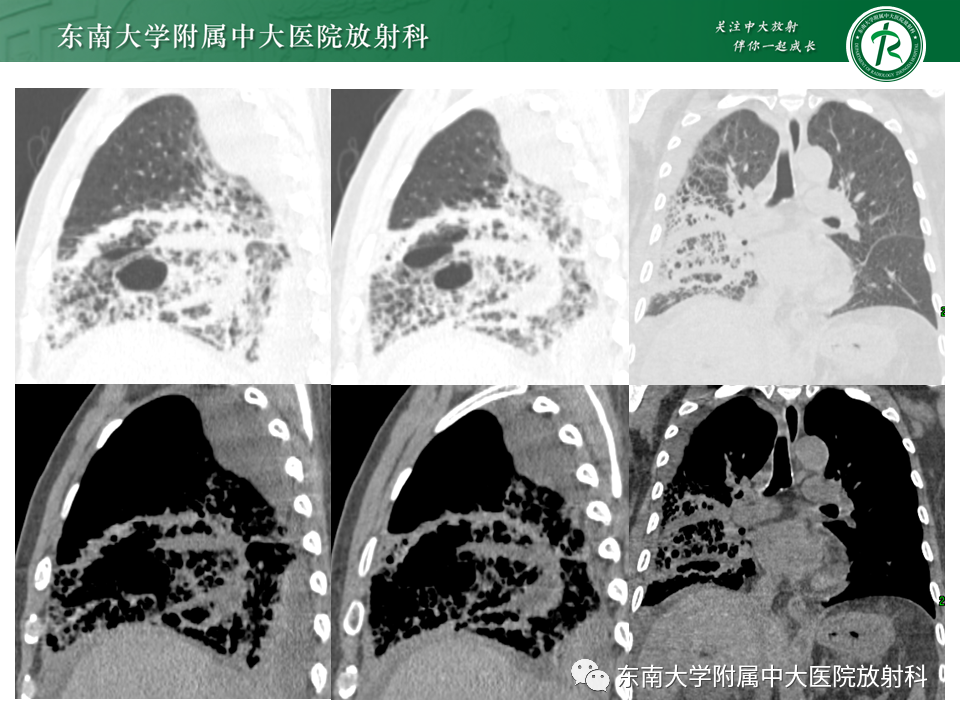 影像PPT - 【PPT】“反晕征”相关病变及鉴别-9