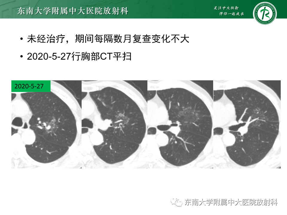 影像PPT - 【PPT】“反晕征”相关病变及鉴别-12