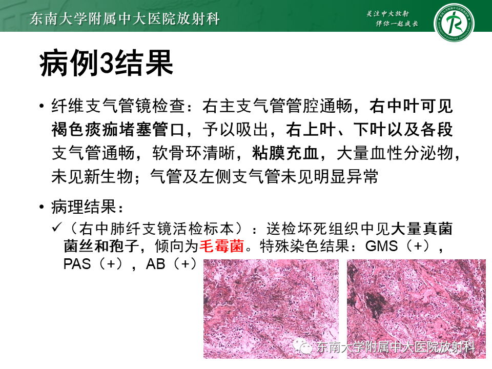 影像PPT - 【PPT】“反晕征”相关病变及鉴别-15