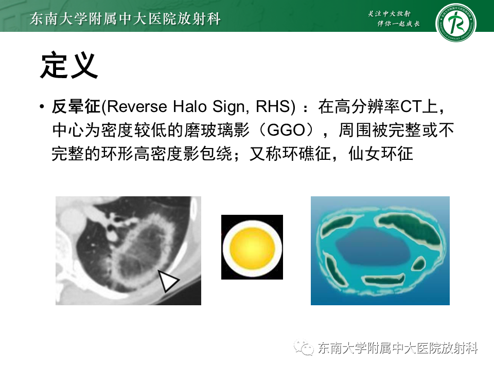 影像PPT - 【PPT】“反晕征”相关病变及鉴别-20