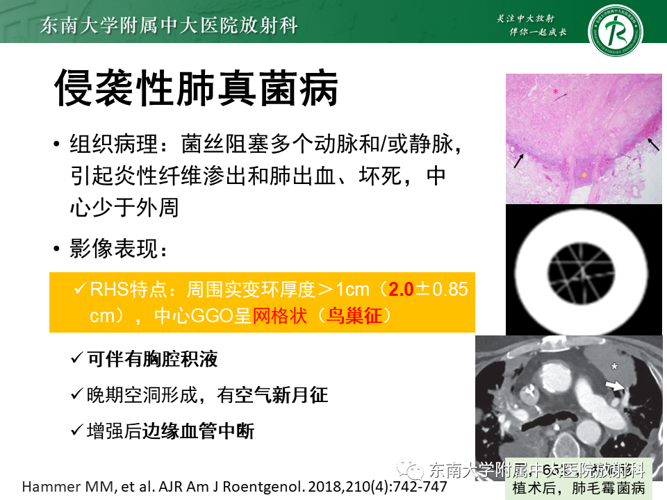 影像PPT - 【PPT】“反晕征”相关病变及鉴别-29