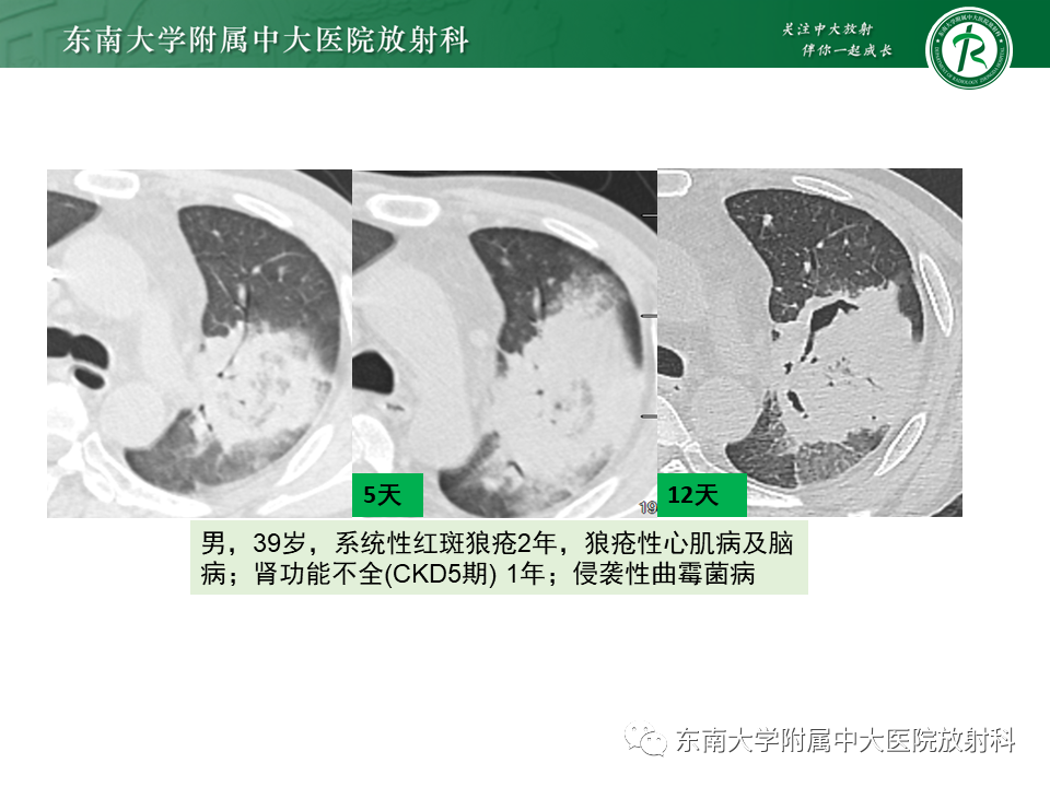 影像PPT - 【PPT】“反晕征”相关病变及鉴别-30