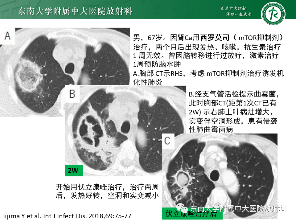 影像PPT - 【PPT】“反晕征”相关病变及鉴别-31