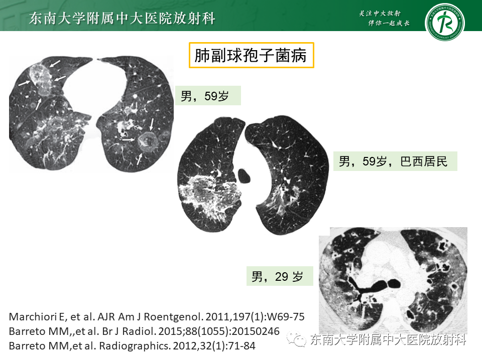 影像PPT - 【PPT】“反晕征”相关病变及鉴别-35