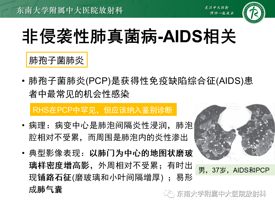 影像PPT - 【PPT】“反晕征”相关病变及鉴别-37