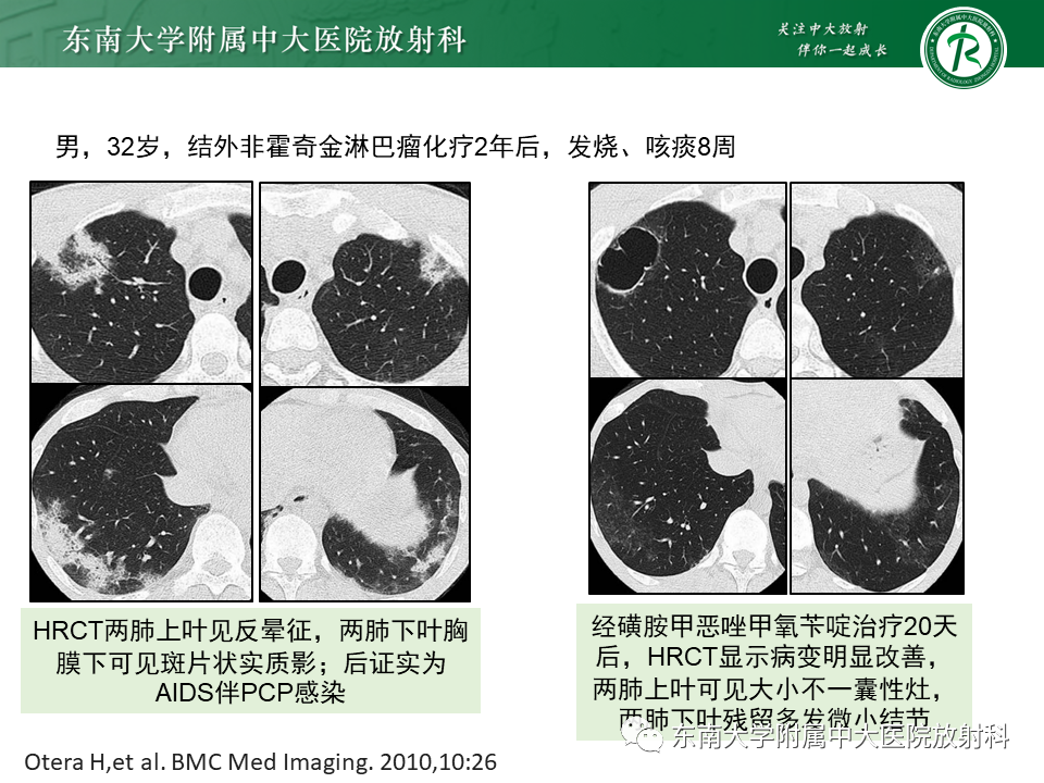 影像PPT - 【PPT】“反晕征”相关病变及鉴别-38