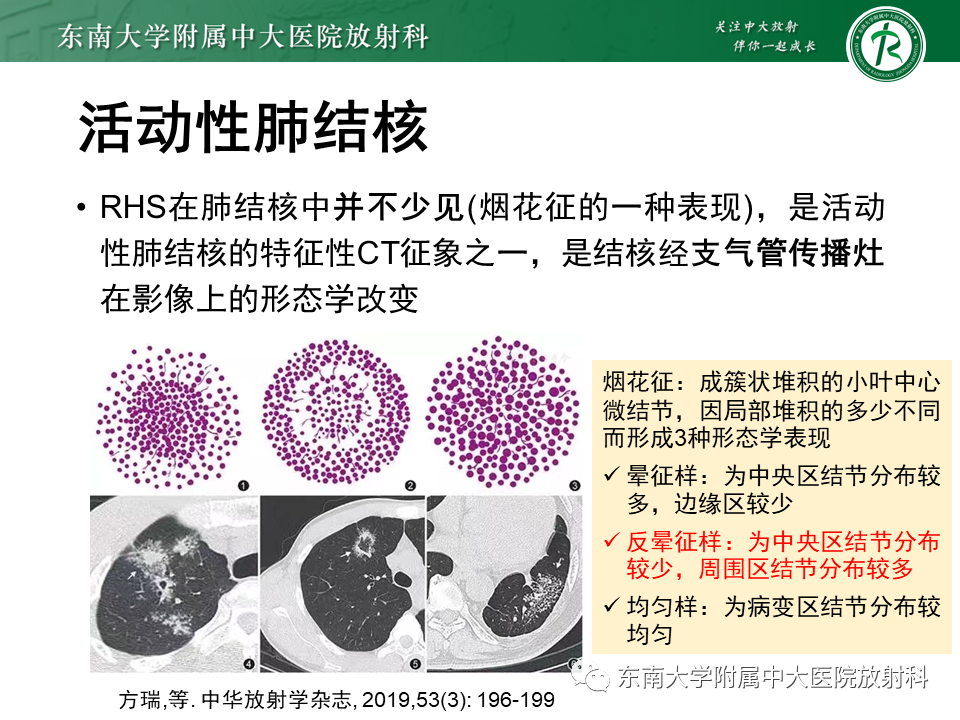 影像PPT - 【PPT】“反晕征”相关病变及鉴别-40