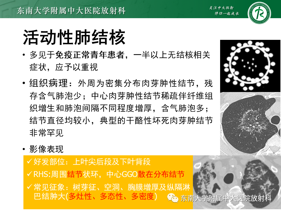 影像PPT - 【PPT】“反晕征”相关病变及鉴别-41