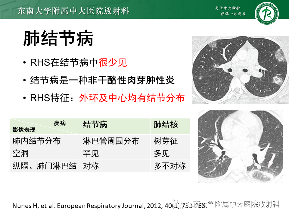 影像PPT - 【PPT】“反晕征”相关病变及鉴别-43