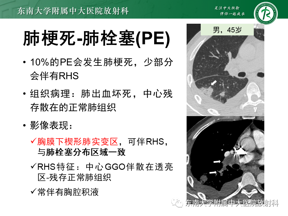 影像PPT - 【PPT】“反晕征”相关病变及鉴别-48