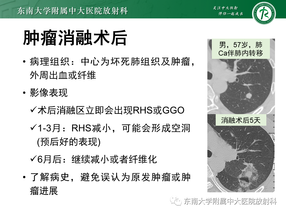 影像PPT - 【PPT】“反晕征”相关病变及鉴别-49