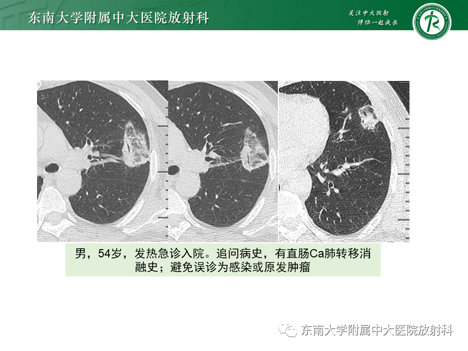 影像PPT - 【PPT】“反晕征”相关病变及鉴别-50