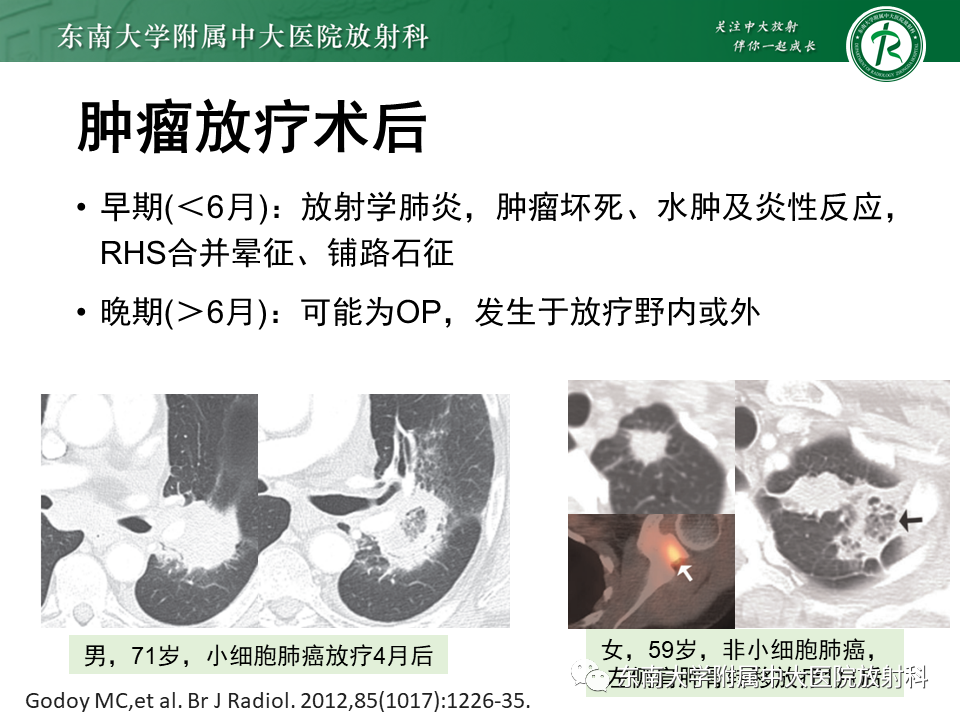 影像PPT - 【PPT】“反晕征”相关病变及鉴别-51