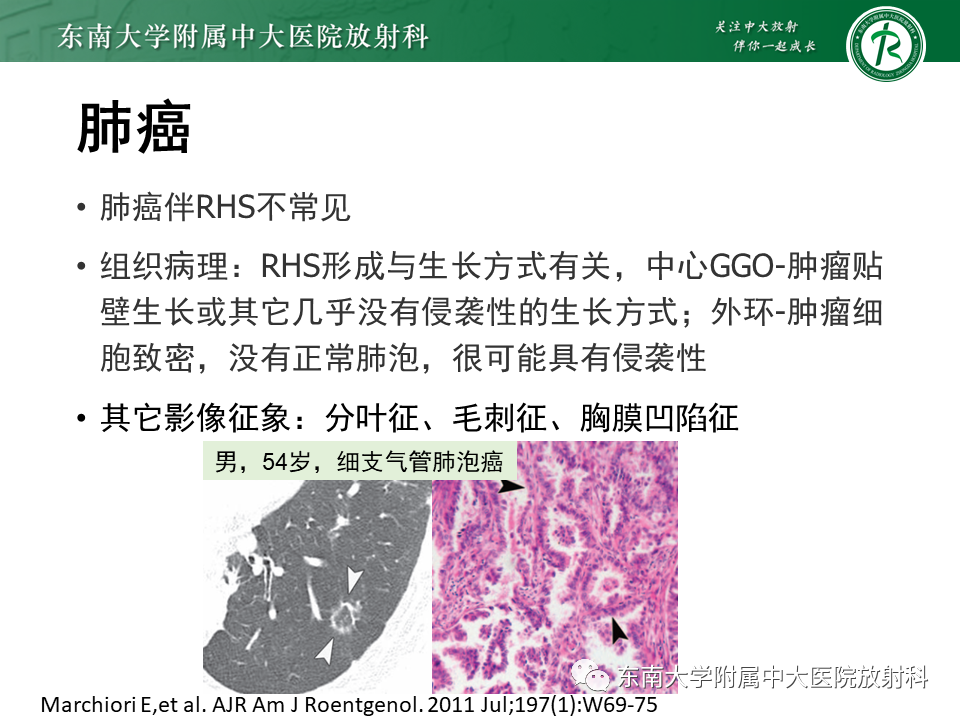 影像PPT - 【PPT】“反晕征”相关病变及鉴别-52