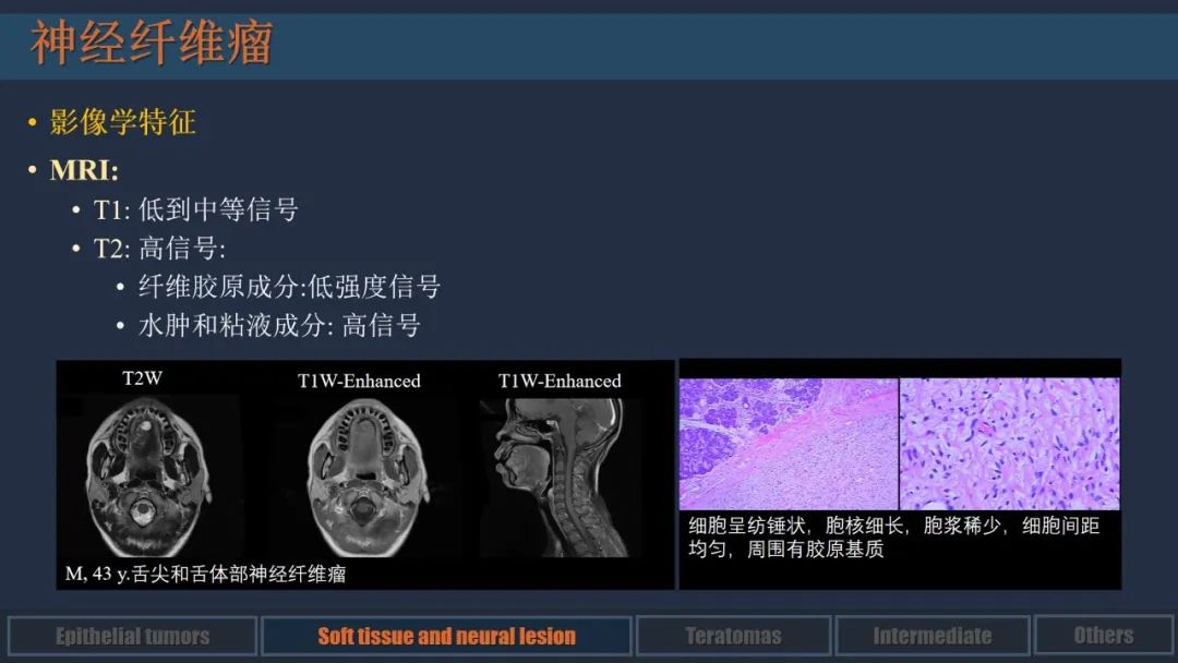 影像PPT - 【PPT】舌良性肿瘤及肿瘤样病变的MR表现及影像与病理对照分析-5 影像PPT - 【PPT】舌良性肿瘤及肿瘤样病变的MR表现及影像与病理对照分析-5
