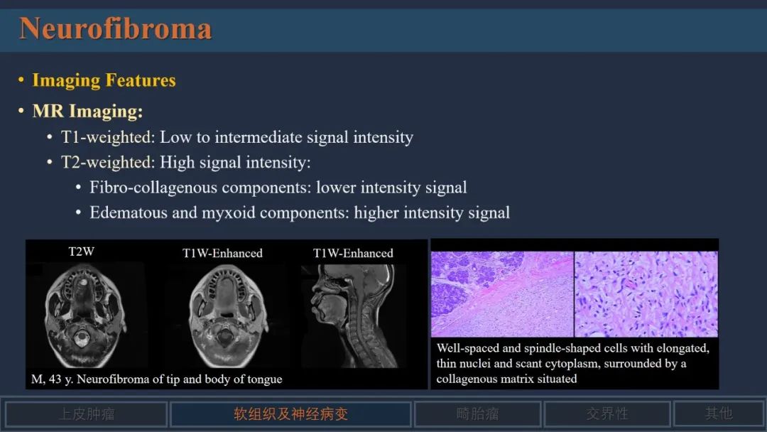 影像PPT - 【PPT】舌良性肿瘤及肿瘤样病变的MR表现及影像与病理对照分析-6 影像PPT - 【PPT】舌良性肿瘤及肿瘤样病变的MR表现及影像与病理对照分析-6