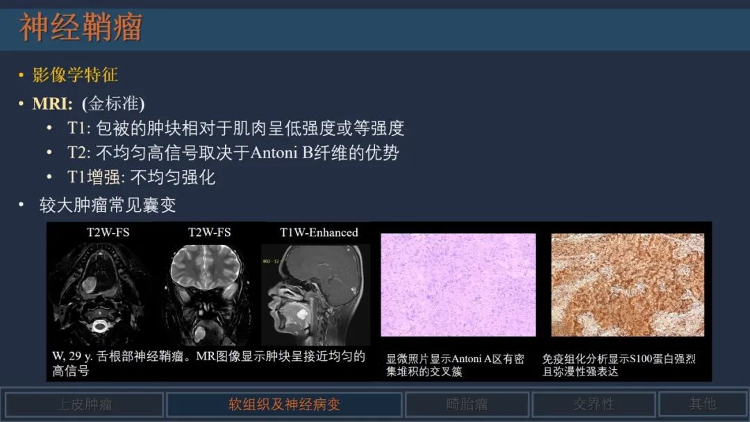 影像PPT - 【PPT】舌良性肿瘤及肿瘤样病变的MR表现及影像与病理对照分析-4 影像PPT - 【PPT】舌良性肿瘤及肿瘤样病变的MR表现及影像与病理对照分析-4