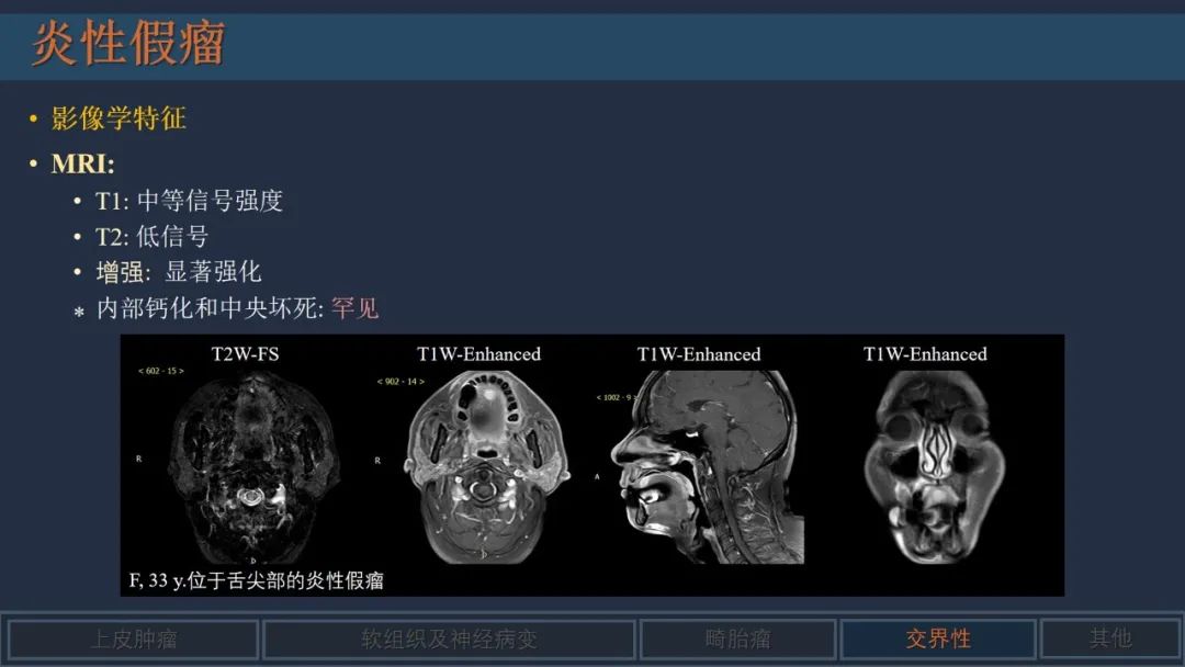 影像PPT - 【PPT】舌良性肿瘤及肿瘤样病变的MR表现及影像与病理对照分析-27 影像PPT - 【PPT】舌良性肿瘤及肿瘤样病变的MR表现及影像与病理对照分析-27