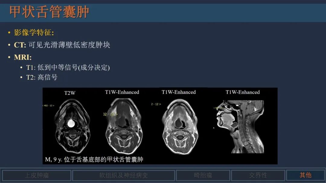 影像PPT - 【PPT】舌良性肿瘤及肿瘤样病变的MR表现及影像与病理对照分析-31 影像PPT - 【PPT】舌良性肿瘤及肿瘤样病变的MR表现及影像与病理对照分析-31