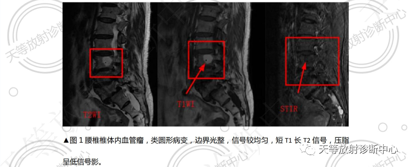 影像PPT - 椎体血管瘤影像学诊断-2 影像PPT - 椎体血管瘤影像学诊断-2