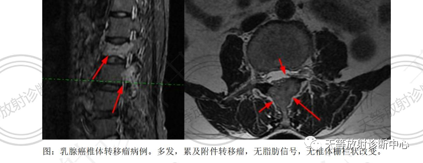 影像PPT - 椎体血管瘤影像学诊断-5 影像PPT - 椎体血管瘤影像学诊断-5