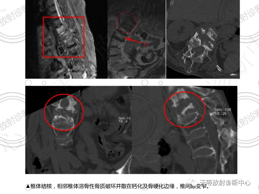 影像PPT - 椎体血管瘤影像学诊断-6 影像PPT - 椎体血管瘤影像学诊断-6