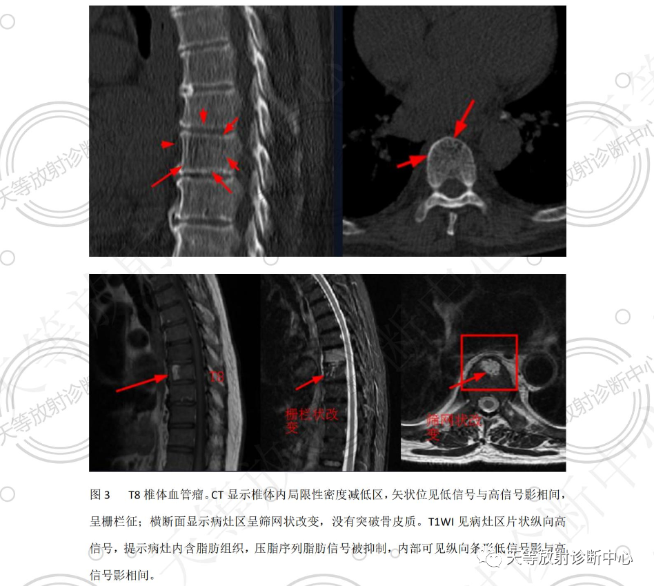 影像PPT - 椎体血管瘤影像学诊断-4 影像PPT - 椎体血管瘤影像学诊断-4