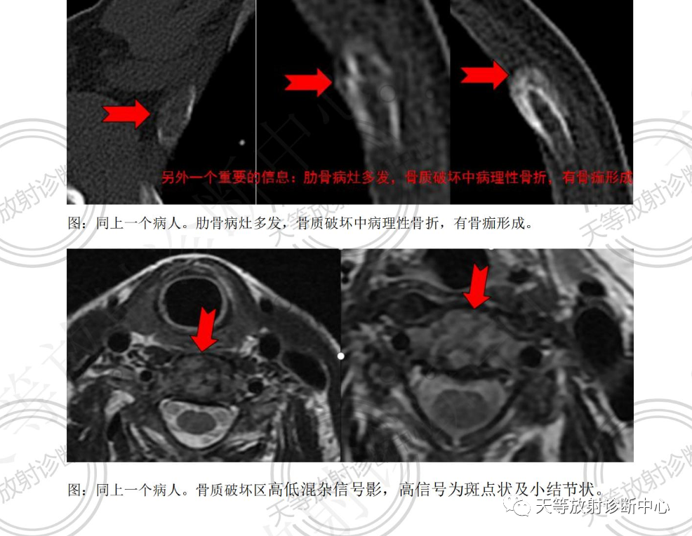 影像PPT - 椎体血管瘤影像学诊断-8 影像PPT - 椎体血管瘤影像学诊断-8