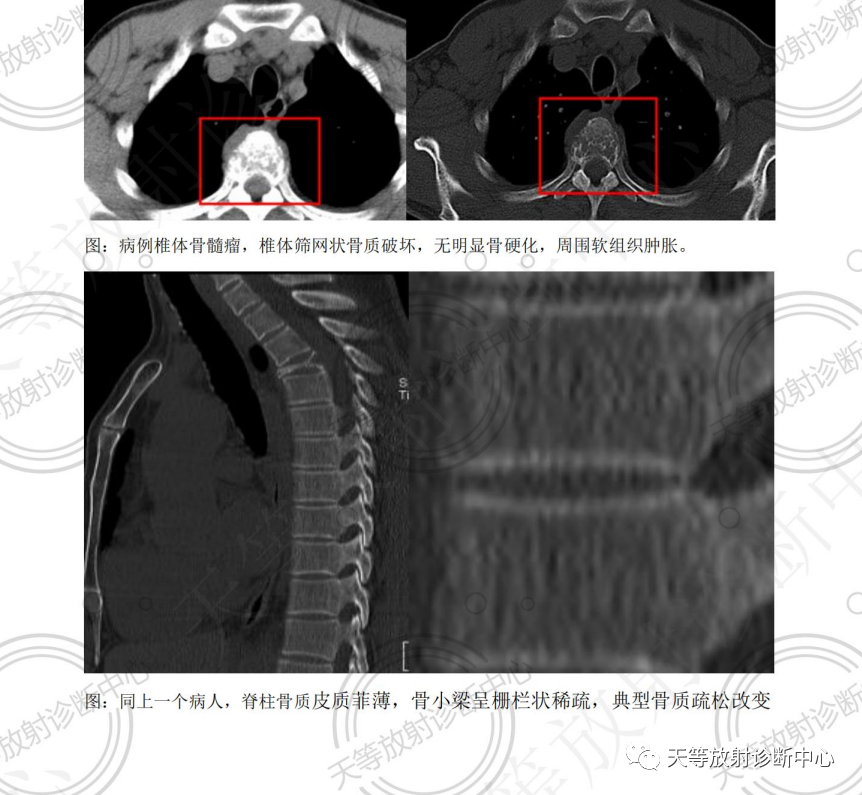 影像PPT - 椎体血管瘤影像学诊断-7 影像PPT - 椎体血管瘤影像学诊断-7