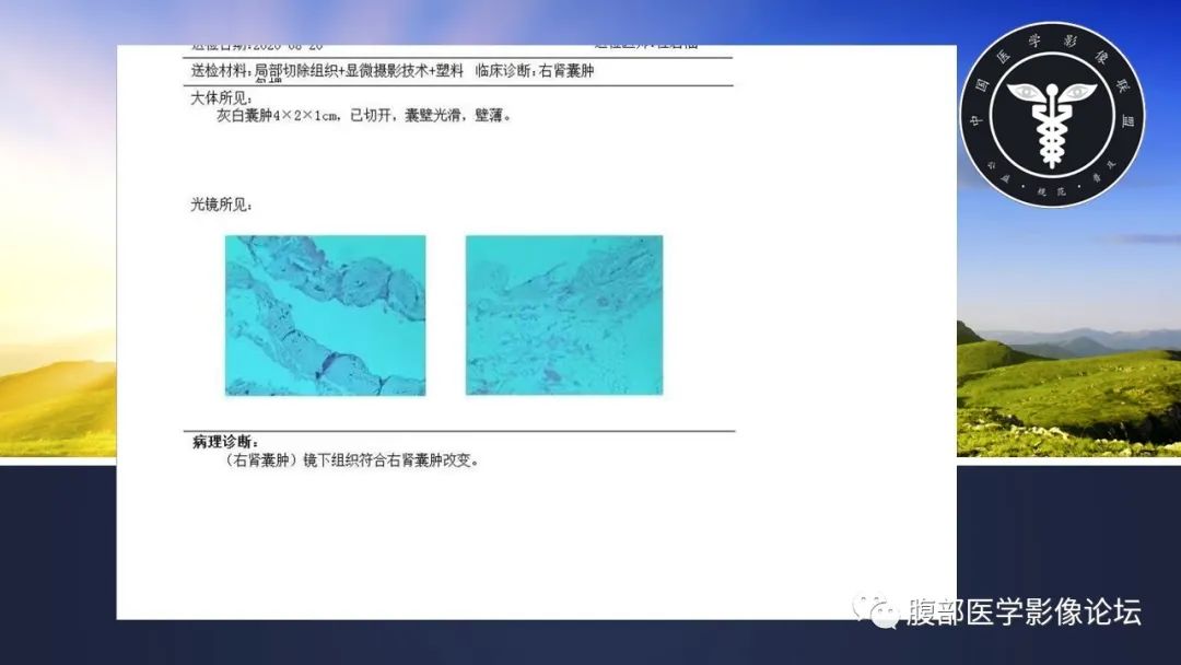 影像PPT - 【病例】肾脏囊肿1例CT影像-11