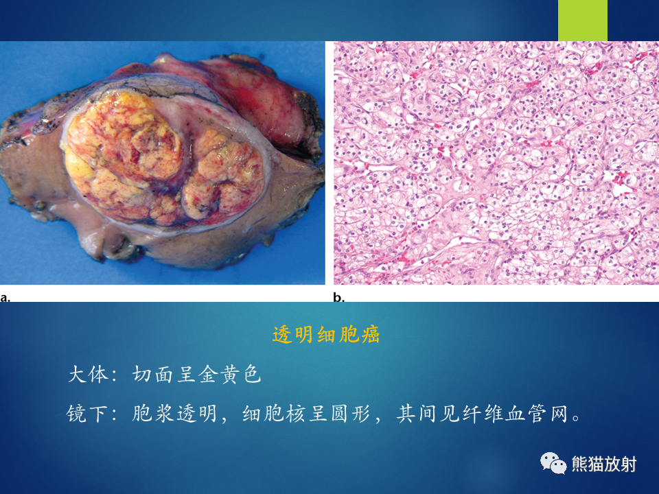 影像PPT - 【病例】肾脏囊肿1例CT影像-17
