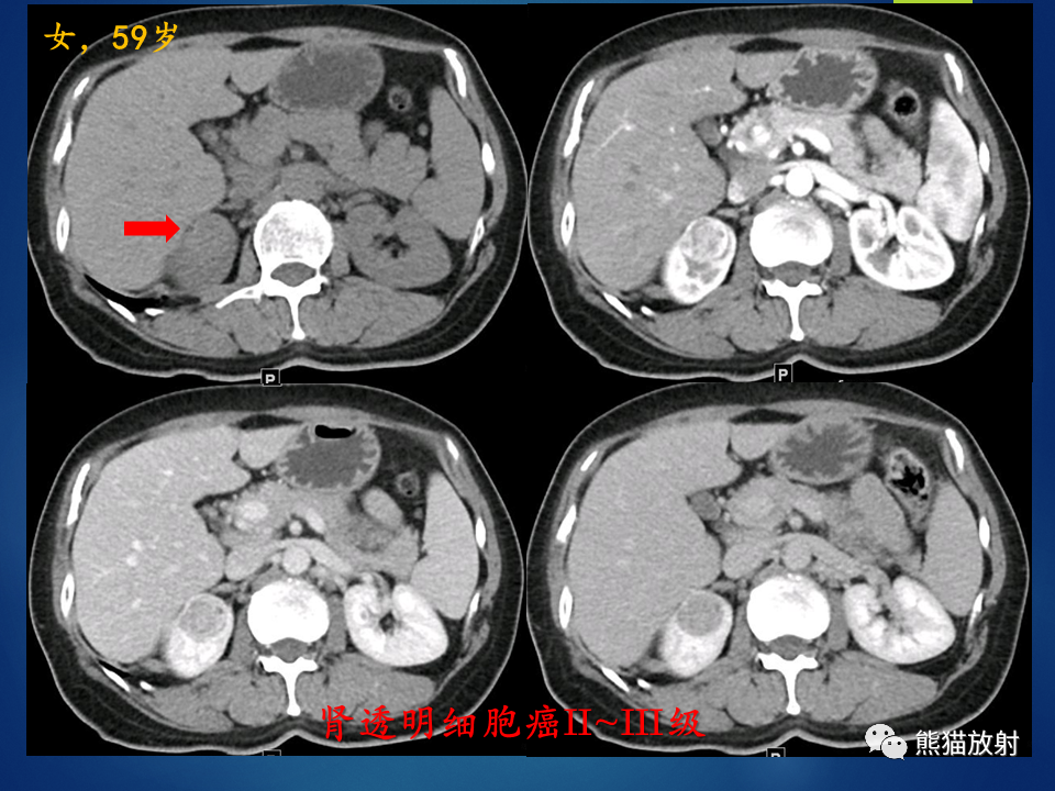 影像PPT - 【病例】肾脏囊肿1例CT影像-18