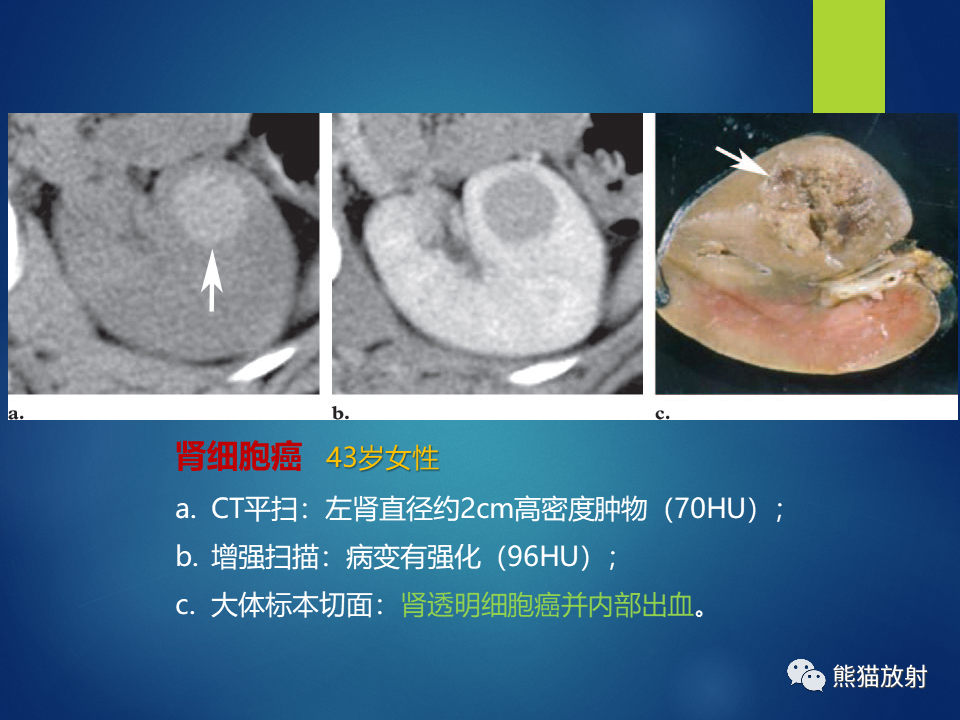 影像PPT - 【病例】肾脏囊肿1例CT影像-19