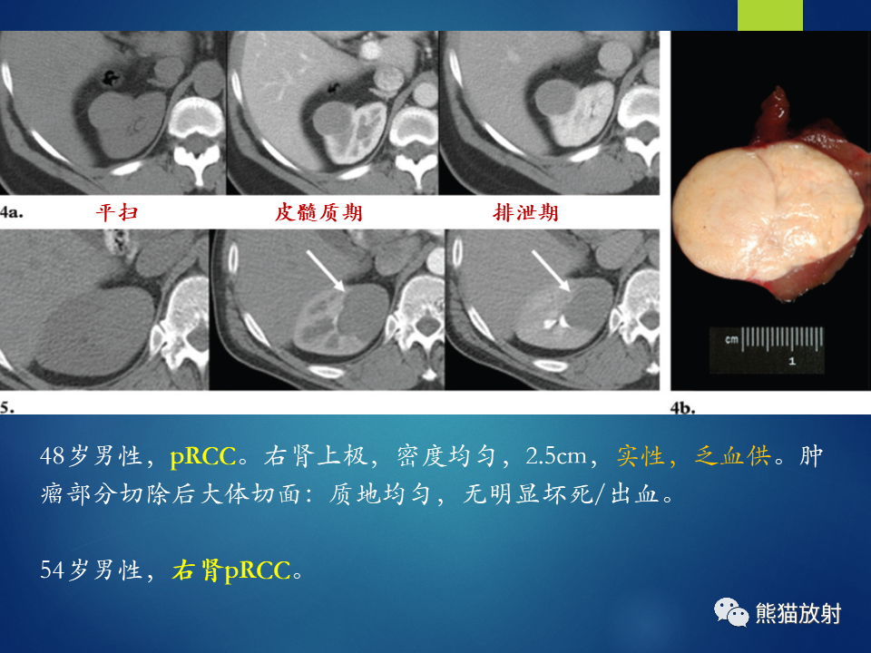 影像PPT - 【病例】肾脏囊肿1例CT影像-23