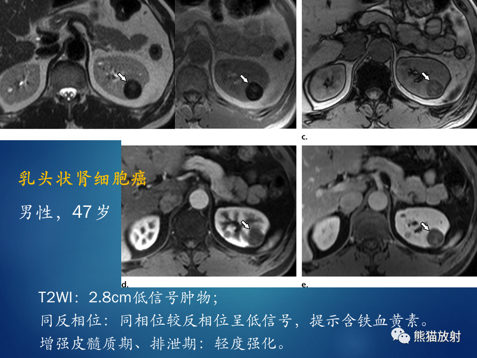 影像PPT - 【病例】肾脏囊肿1例CT影像-24