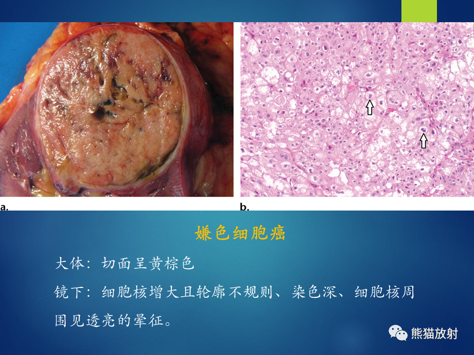 影像PPT - 【病例】肾脏囊肿1例CT影像-26