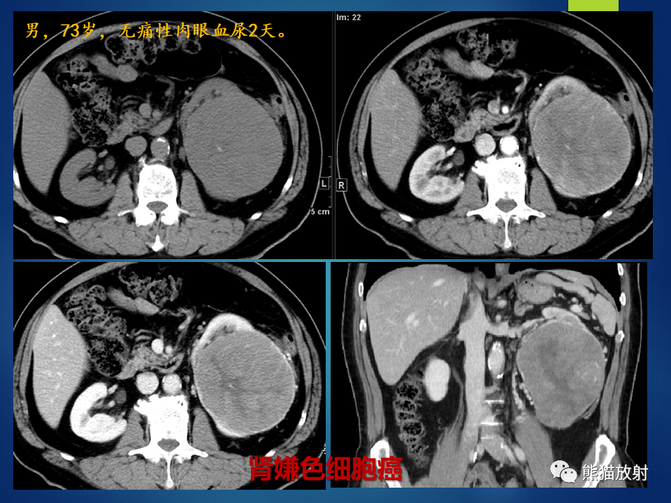 影像PPT - 【病例】肾脏囊肿1例CT影像-27