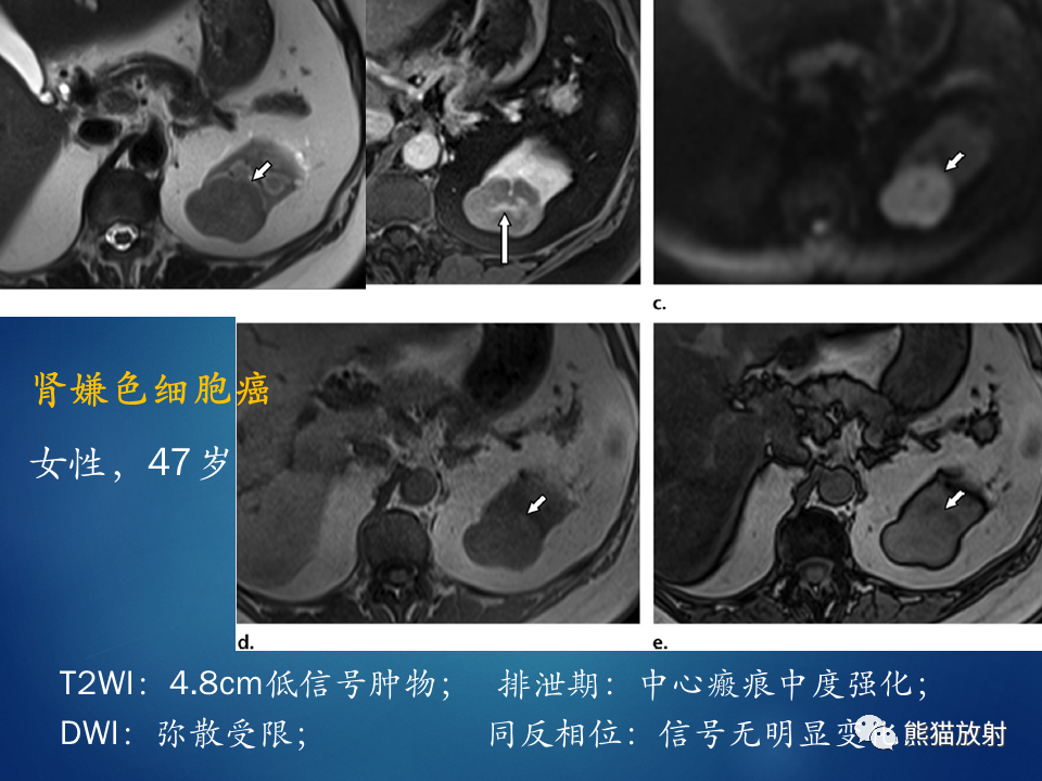 影像PPT - 【病例】肾脏囊肿1例CT影像-28