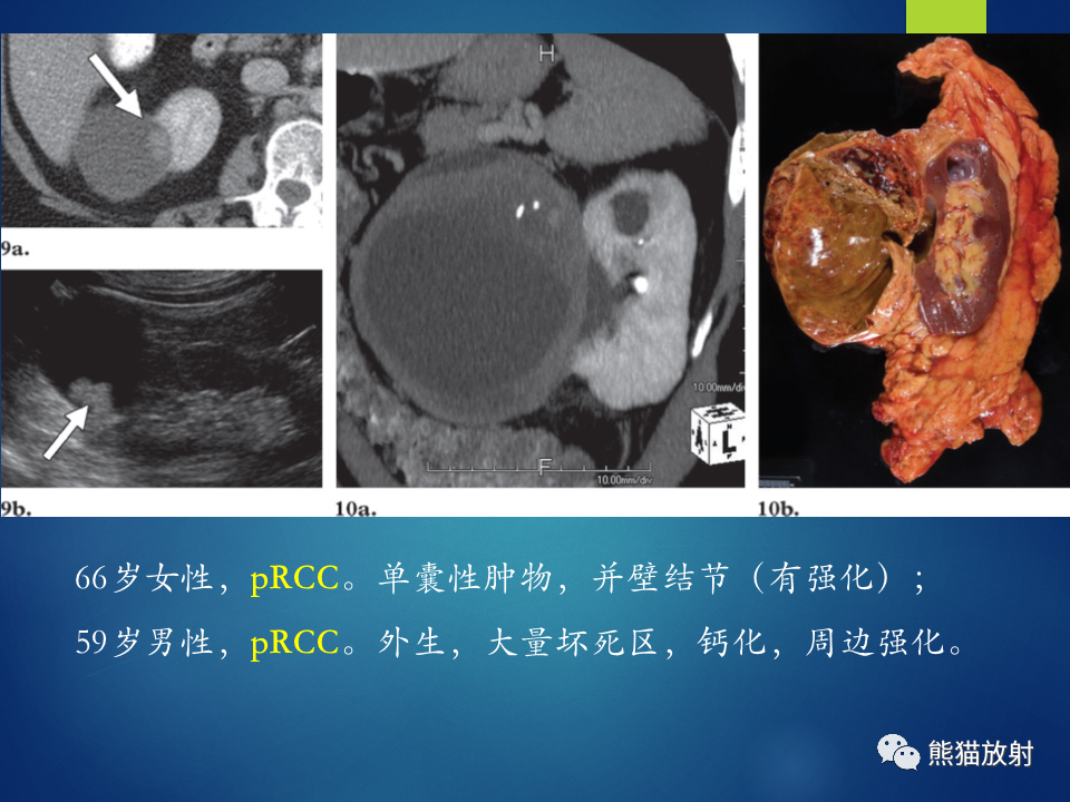 影像PPT - 【病例】肾脏囊肿1例CT影像-25