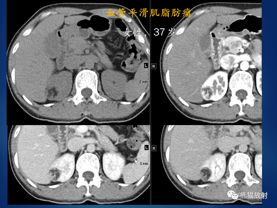 影像PPT - 【病例】肾脏囊肿1例CT影像-30