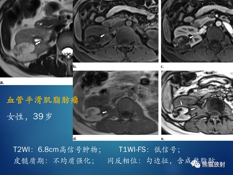 影像PPT - 【病例】肾脏囊肿1例CT影像-31
