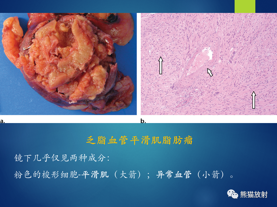 影像PPT - 【病例】肾脏囊肿1例CT影像-32