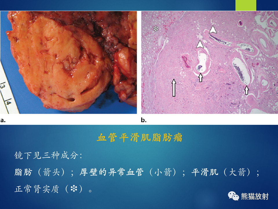 影像PPT - 【病例】肾脏囊肿1例CT影像-29