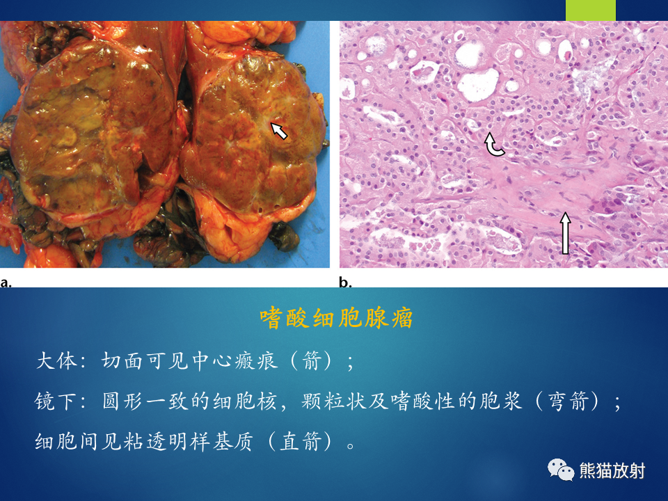 影像PPT - 【病例】肾脏囊肿1例CT影像-35