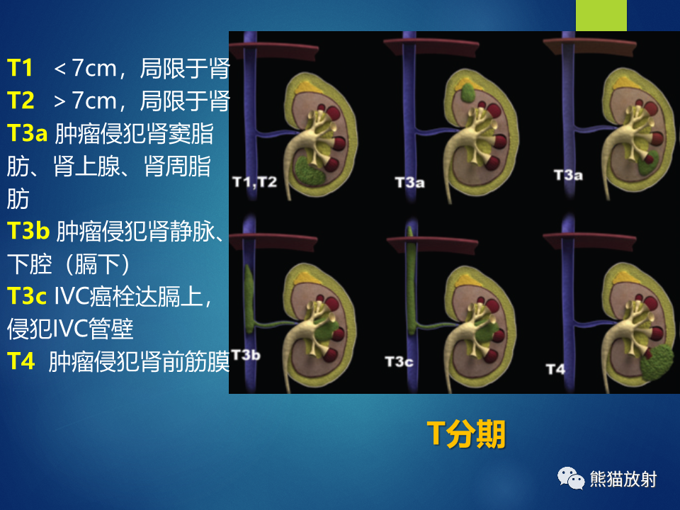 影像PPT - 【病例】肾脏囊肿1例CT影像-41