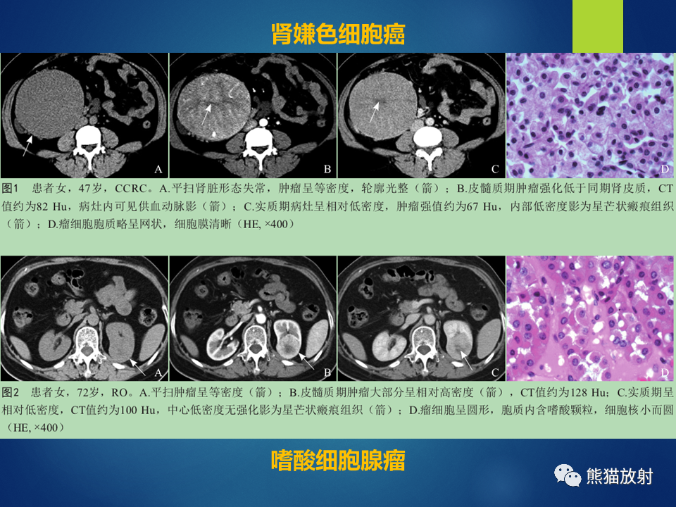 影像PPT - 【病例】肾脏囊肿1例CT影像-38