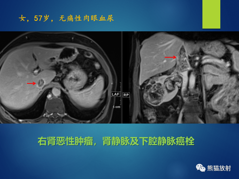 影像PPT - 【病例】肾脏囊肿1例CT影像-44