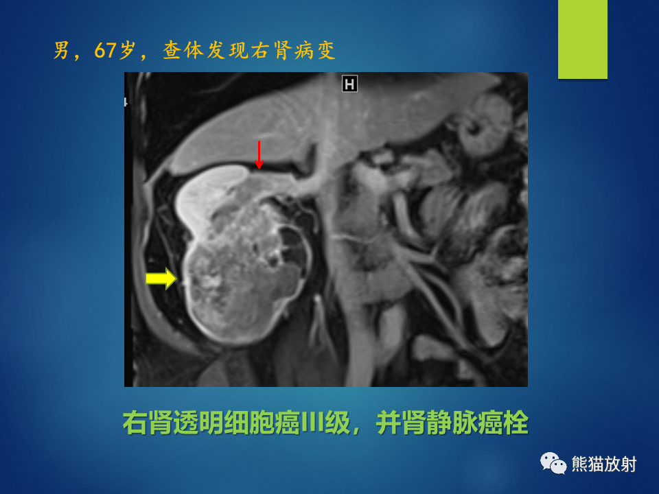 影像PPT - 【病例】肾脏囊肿1例CT影像-43