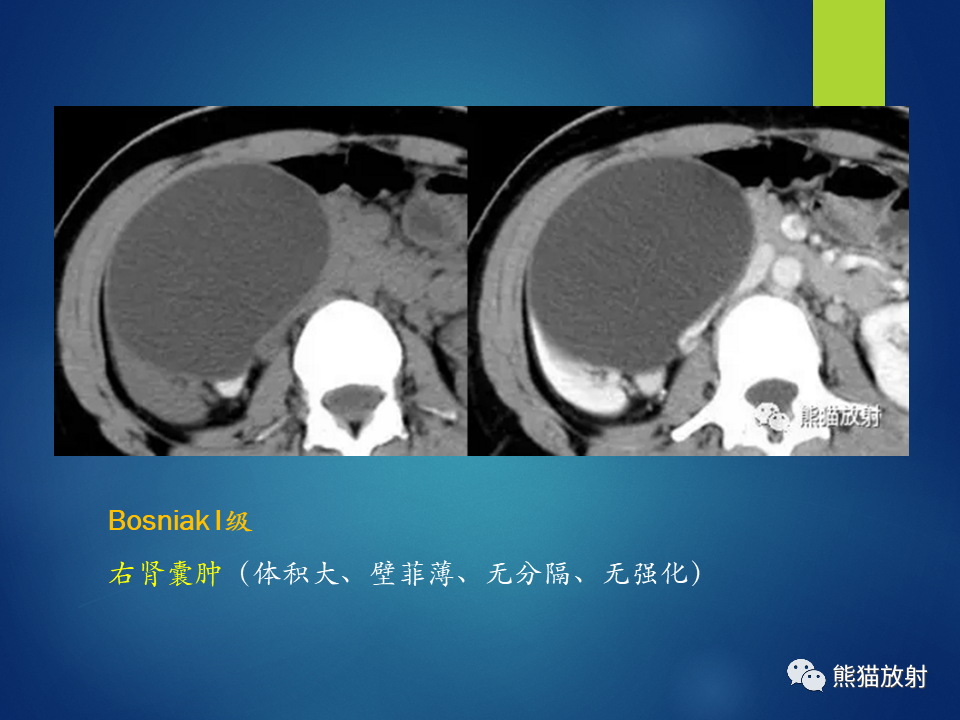 影像PPT - 【病例】肾脏囊肿1例CT影像-48